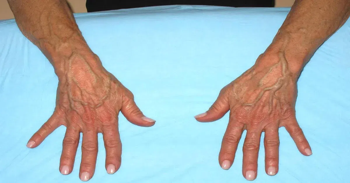 When to be concerned about Blood vessels that suddenly become visible