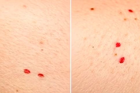 Skin Mystery Solved: What Red Dots Could Really Mean