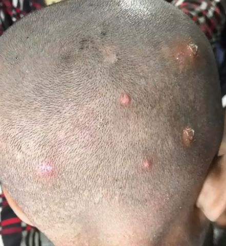 I Found Strange Bumps on My Son’s Head — Then Came the Panic